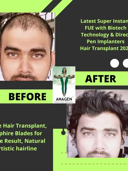 Another example of a successful hair transplant using our latest techniques, resulting in a dense, natural, and artistic hairline.