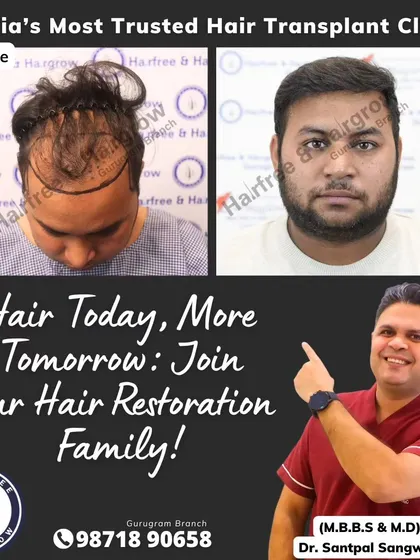 This before-and-after result was achieved with 3226 grafts over 23 months. It shows that with patience and proper care, we can achieve excellent density and a completely natural appearance.