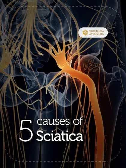 Understanding the causes of sciatica is crucial for effective treatment. This anatomical view shows how issues like a herniated disc can compress the sciatic nerve, leading to pain.