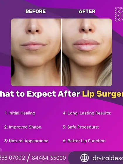 This before-and-after image demonstrates the subtle yet significant impact of lip surgery. My focus is on creating a natural-looking enhancement that restores volume and improves shape, ensuring the results are in perfect harmony with your overall facial features.