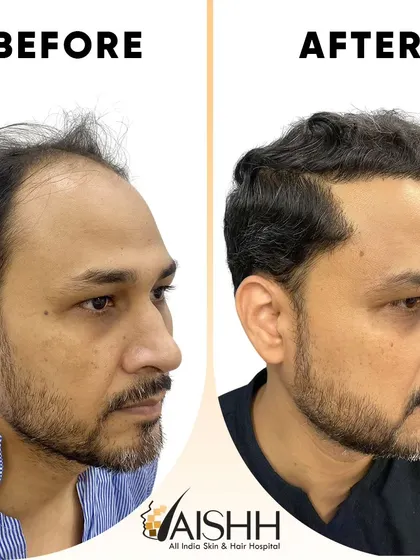 This patient's result highlights the power of a well-executed hair transplant. We restored his receding hairline and added density throughout the frontal region, achieving a much more youthful appearance.
