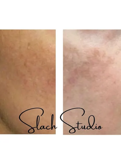 This image focuses on the improvement of skin texture, showing how the treatment can reduce the appearance of pores and rough patches.