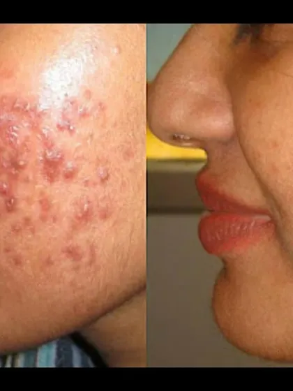 A fantastic transformation showing the journey from inflammatory acne to clear, smooth skin. This was achieved with a personalized medical treatment plan, proving that you don't have to live with persistent breakouts.