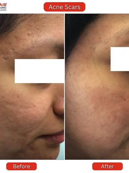 This is the kind of transformation that inspires us every day. This client came to us with deep, textured acne scars and uneven skin tone. Through a personalized treatment plan, we were able to significantly smooth the skin's surface, reduce the depth of the scars, and restore a healthier, more even complexion.