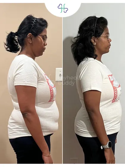 Side view of her 5 kg weight loss. She feels more confident and has transitioned to a healthier lifestyle.