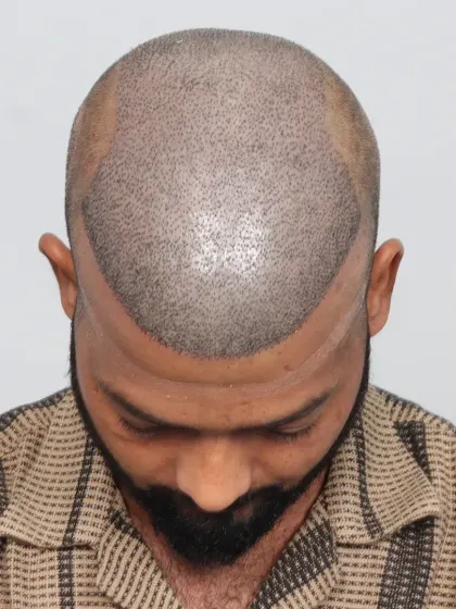This 13-month result for a Grade 6 baldness case shows what's possible with 6300 grafts. We restored his hair, style, and youthful appearance.
