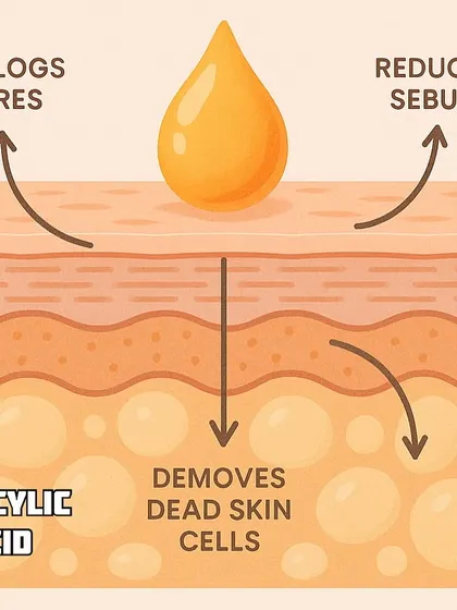 This diagram shows exactly how Salicylic Acid, a key ingredient for acne-prone skin, works. It penetrates into the pores to remove dead skin cells, unclog pores, and reduce sebum, making it a hero ingredient in many of my personalized plans.