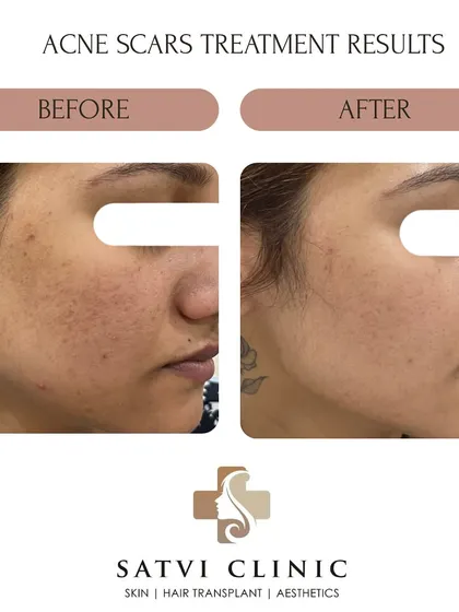 Another example of successful acne scar revision. This patient's results show a visible improvement in rolling scars and post-acne pigmentation. Each treatment plan is customized, and can include procedures like MNRF, chemical peels, or subcision depending on the scar type.
