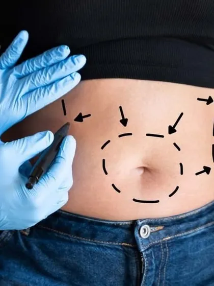This image illustrates the planning stage of liposuction. The markings guide the removal of fat from the abdomen and flanks to achieve a slimmer waist and flatter stomach.