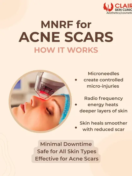 This graphic explains how MNRF for acne scars works. Microneedles create controlled micro-injuries while radiofrequency energy heats deeper skin layers, causing the skin to heal smoother with reduced scarring.