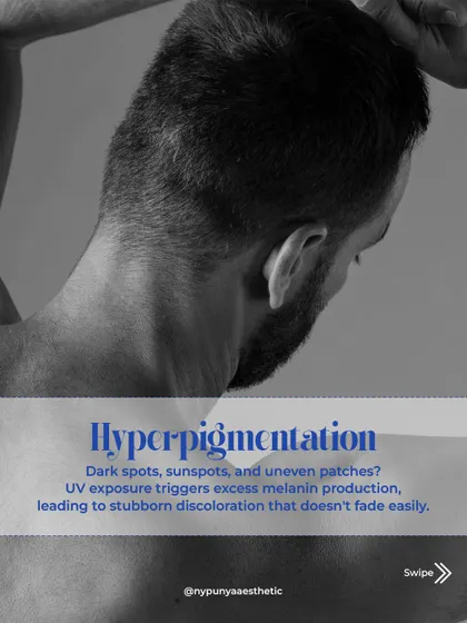 Sun damage often leads to hyperpigmentation. UV exposure triggers excess melanin production, resulting in dark spots and uneven patches that are stubborn to treat.