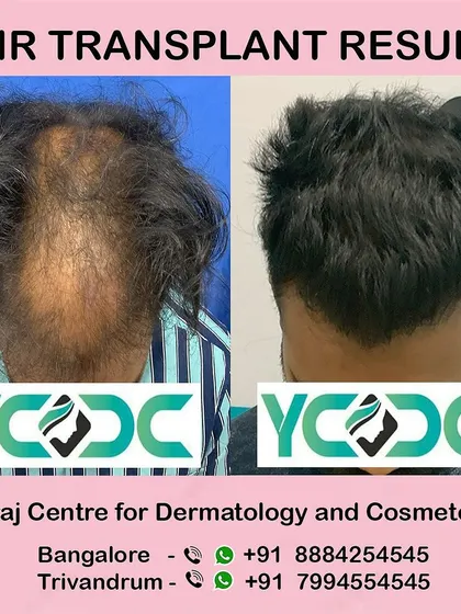 This top-down view shows the impressive coverage achieved for a patient with advanced thinning on the crown and mid-scalp.