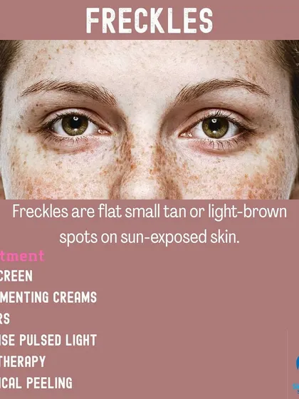 This graphic provides information on freckles, which are small tan spots on sun exposed skin. I offer various treatments, including lasers and chemical peels, to effectively reduce their appearance.