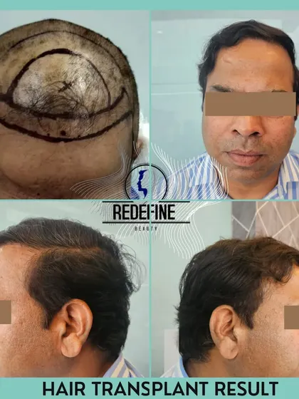 A successful hair transplant is a team effort. Here you can see the planning stage, where we map out the new hairline, and the final result. We ensure every graft is placed meticulously for a dense, natural look that lasts a lifetime.