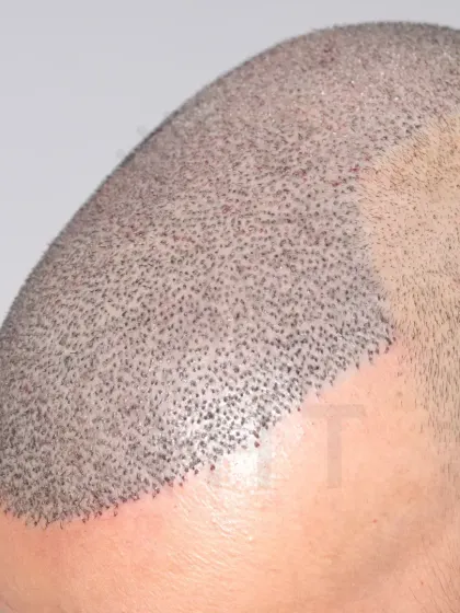 A close-up of graft placement for a Norwood Grade 6 case. 6000 grafts were implanted in a single session for full coverage.