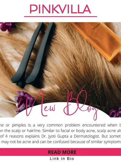 In this article, I discuss the causes of scalp acne, which can range from clogged pores to bacterial growth. Understanding the root cause is essential for finding the right treatment and preventing future breakouts.