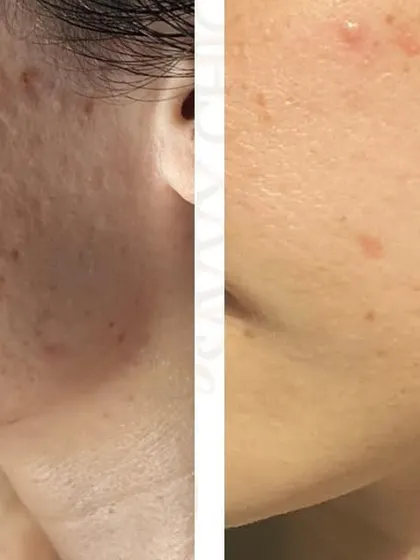 Treating deep acne scars requires patience and a powerful approach. This transformation highlights the effectiveness of multiple laser sessions in softening the edges of scars and improving the overall skin surface, restoring confidence.