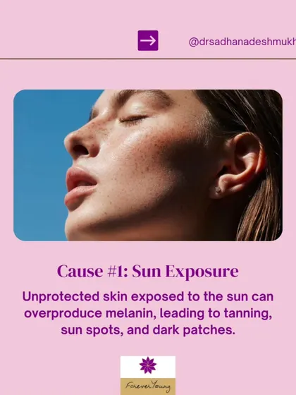 Sun exposure is the number one cause of hyperpigmentation. When your skin is unprotected, UV rays trigger an overproduction of melanin, leading to tanning, sun spots, and dark patches. Consistent use of a broad-spectrum sunscreen is the most critical step in preventing and treating this concern.