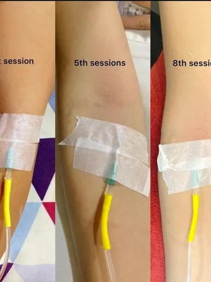 This image demonstrates the typical progression of a multi-session Glutathione treatment. It shows the visible change in skin tone from the first to the eighth session, illustrating the product's efficacy.