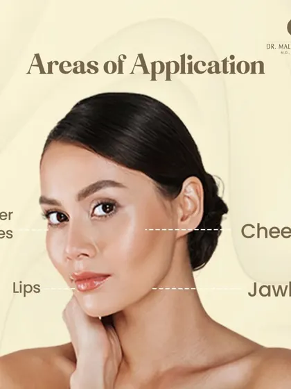 Dermal fillers can be applied to various areas of the face. Common treatment zones include the under eyes to reduce hollowness, the cheeks to restore volume, the lips for enhancement, and the jawline for definition.