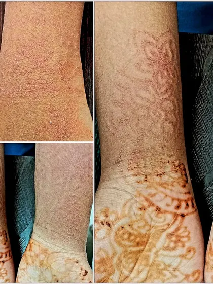 A beautiful mehendi design can sometimes cause a painful allergic reaction known as Irritant Contact Dermatitis. This image shows the rashes and irritation that can occur. I always recommend doing a patch test before applying mehendi for an event and seeing a dermatologist immediately if you notice any irritation or swelling.