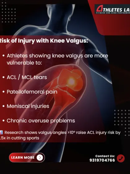 The risks associated with knee valgus are significant. Athletes with this movement fault are more vulnerable to ACL tears, patellofemoral pain, and meniscal injuries. Research shows it can increase ACL injury risk by 2.5 times in cutting sports.