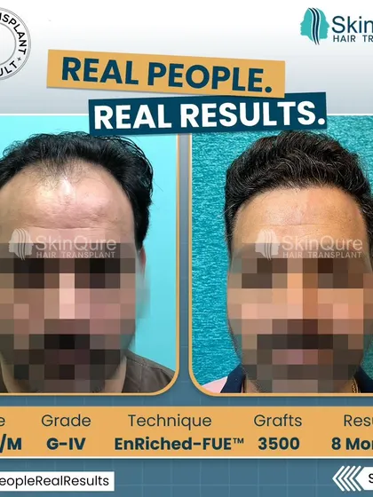 For this 35-year-old patient with Grade IV hair loss, we implanted 3500 grafts. The 8-month 'after' photo shows a significant improvement in coverage and a well-defined, natural hairline that looks completely his own.
