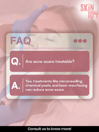 FAQ: Are acne scars treatable? Yes, absolutely. We use a combination of treatments like microneedling, chemical peels, and laser resurfacing to significantly reduce the appearance of acne scars.