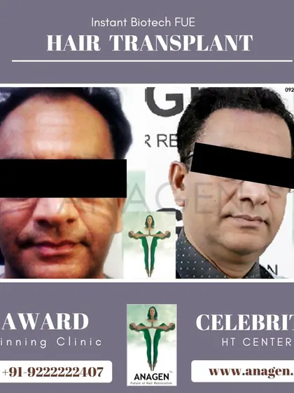 An excellent result from our Instant Biotech FUE hair transplant. This before and after image shows a significant improvement in hair density and overall appearance.