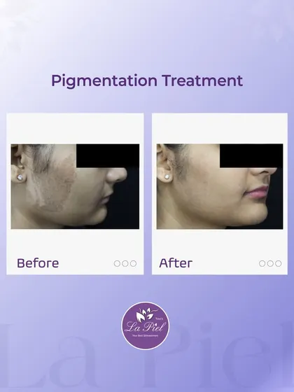 Pigmentation can make skin appear uneven and dull, but with targeted treatments, we can restore its natural clarity. This transformation shows a significant reduction in pigmentation, resulting in a brighter and more even-toned complexion, achieved through a plan designed specifically for Indian skin.