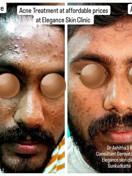 This before and after comparison highlights the results of a tailored acne vulgaris treatment. My goal is to provide the best tried and tested options for achieving acne-free skin.