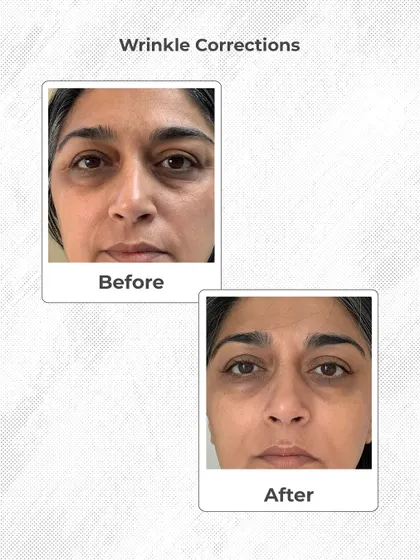 This is a real result from one of my patients. We focused on reducing under-eye wrinkles and fine lines for a fresher, more rested appearance. My goal is always to provide natural-looking anti-aging results that restore your confidence.