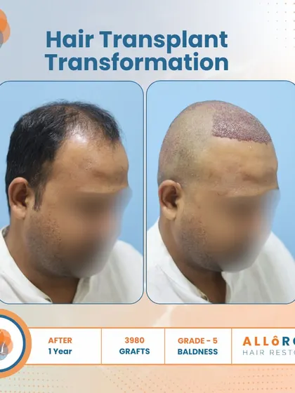 A one-year transformation for a Grade 5 baldness case using 3980 grafts. The images show the before, the immediate post-op, and the final result, demonstrating the entire process and its successful outcome.