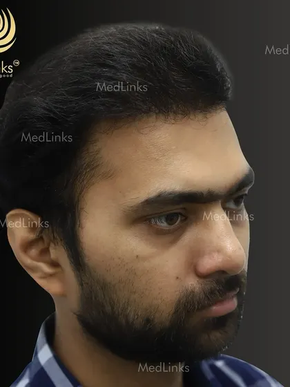 The final result from the side, showing a natural and dense hairline.