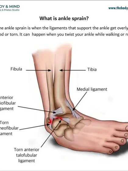 An ankle sprain occurs when ligaments are overstretched or torn. This diagram shows the specific ligaments commonly affected.