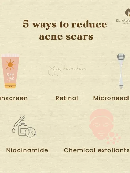 This infographic outlines five effective ways to reduce acne scars. A multi-faceted approach using sunscreen, retinol, microneedling, niacinamide, and chemical exfoliants can significantly improve skin texture.