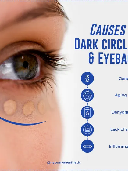 The causes for both dark circles and eye bags can include genetics, aging skin, dehydration, lack of sleep, and inflammation.
