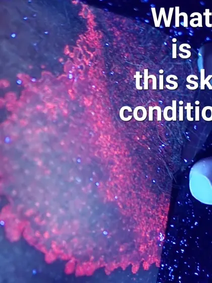 This image shows a skin condition called Erythrasma as seen under a special diagnostic tool called a Wood's lamp. The distinct coral red glow is caused by bacteria and helps me differentiate it from a fungal infection. An accurate diagnosis is the first step to effective treatment, as not every itch or rash in the groin is an STD.