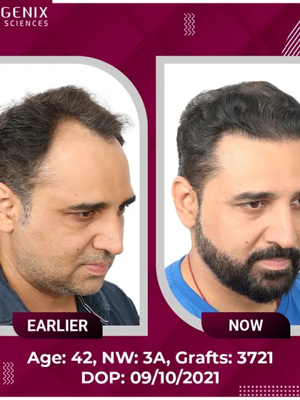 TV Actor Romanch Mehta shows his incredible transformation and explains how our results convinced him to overcome his fear of surgery.