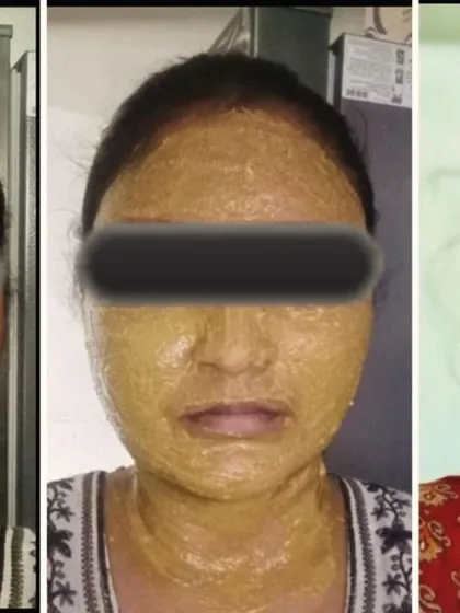 This is a wonderful three-step transformation photo from a customer. It shows her skin before, during the application of one of my face packs, and the glowing result after. This is what consistent, natural skincare can do.