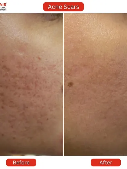 Notice the dramatic improvement in both the redness and the pitted texture of the skin. This transformation showcases how our treatments reduce inflammation and resurface the skin for an even tone and feel.