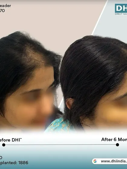 A side-profile view of a 30-year-old female client 6 months after her no-shave hair transplant. We implanted 1,886 hairs to restore her hairline, achieving a natural and beautiful result.