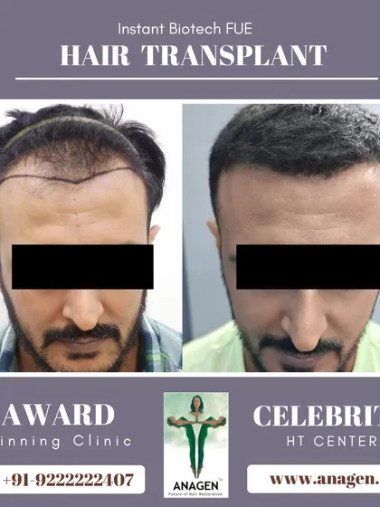 A great before and after result from our Instant Biotech FUE hair transplant. The patient's new hairline is natural and well defined.