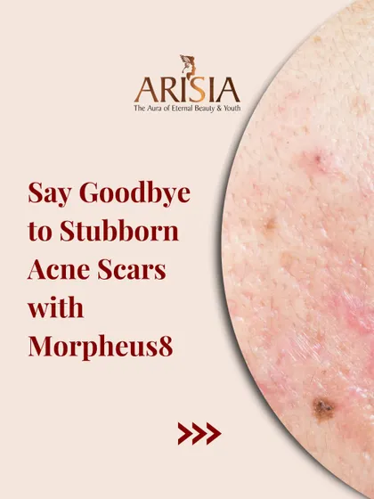 Say goodbye to stubborn acne scars with Morpheus8. This treatment is highly effective for resurfacing the skin and promoting deep collagen remodeling to smooth out textural irregularities.