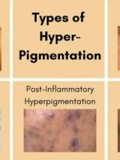 Sun spots, freckles, and melasma are distinct conditions that require different approaches. I create tailored treatment plans that may include lasers, peels, or topical creams to effectively target your specific type of hyperpigmentation.