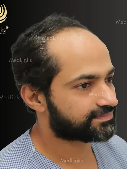 The patient's hair from the side before the procedure.