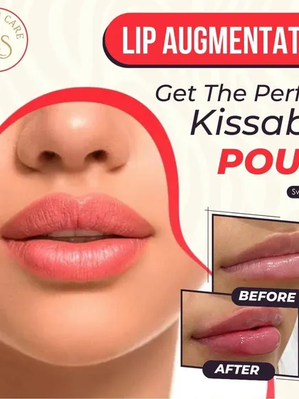 Achieve the perfect pout with lip augmentation. This treatment uses hyaluronic acid fillers to add volume and shape, giving you natural-looking, kissable lips as seen in this before and after comparison.