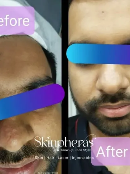 A fantastic before-and-after result from just one session of my Signature Facial Treatment. The improvement in skin tone, reduction in dullness, and overall radiant glow are clearly visible.