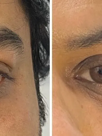 This close-up before-and-after shows a visible reduction in under-eye darkness and puffiness, resulting in a more refreshed appearance.