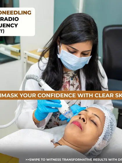 Dr. Vindhya performs a Microneedling with Radio Frequency (Secret RF) treatment. This procedure stimulates collagen deep within the skin to effectively reduce acne scars and improve texture.